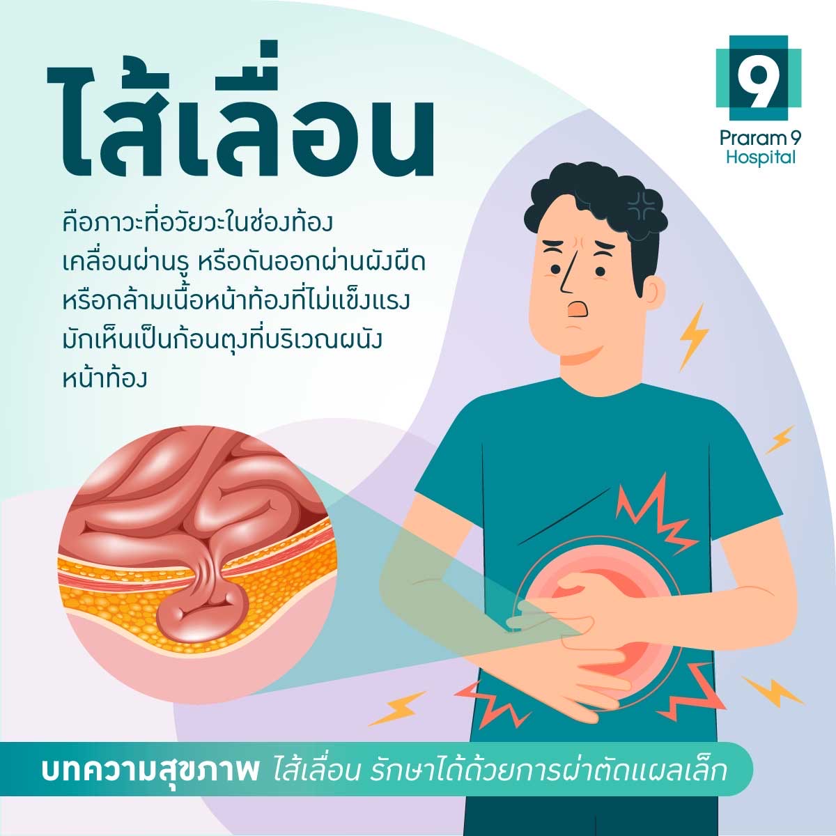 ไส้เลื่อนคือ