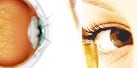 เบาหวานขึ้นตา (Diabetic retinopathy)