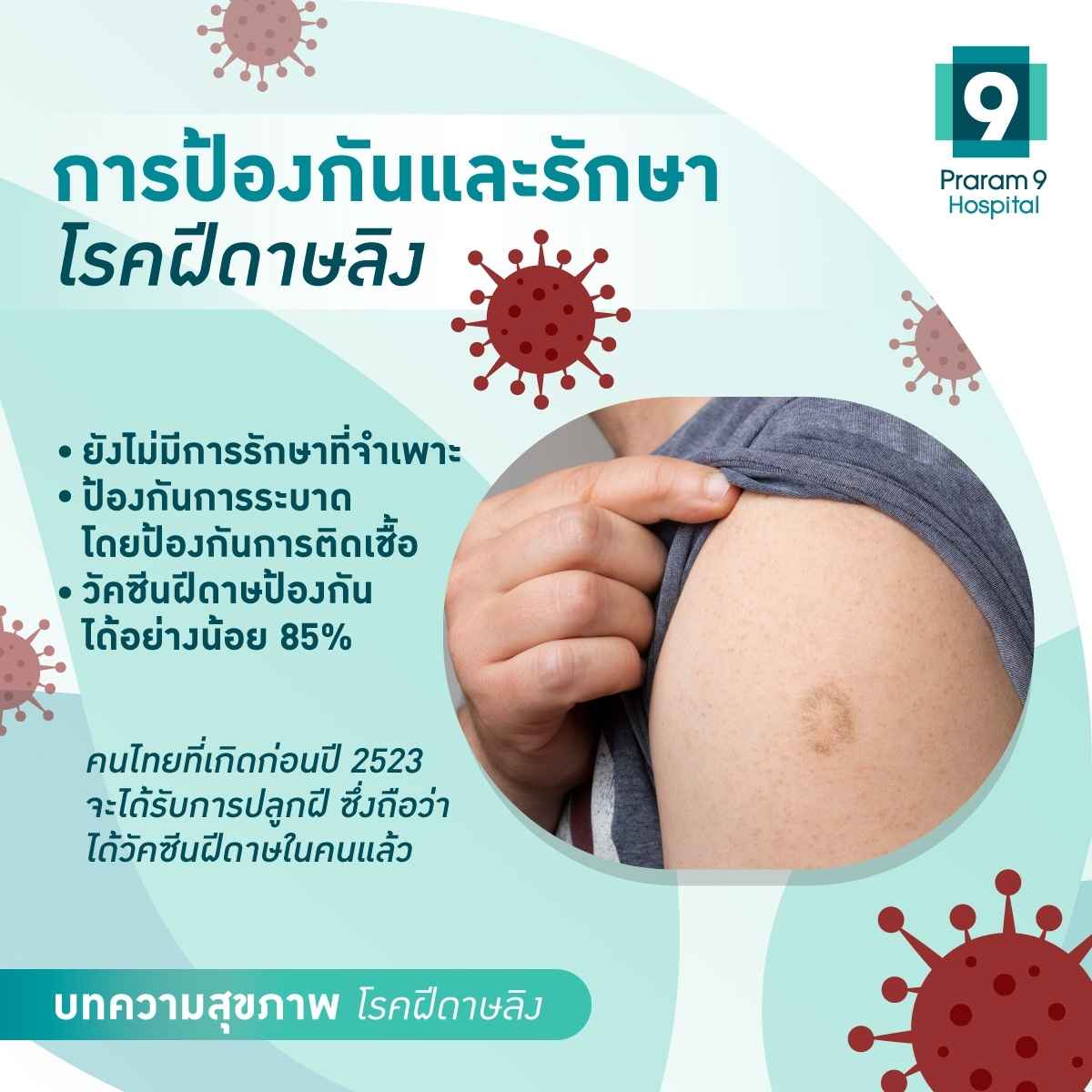 การป้องกันและรักษาโรคฝีดาษลิง