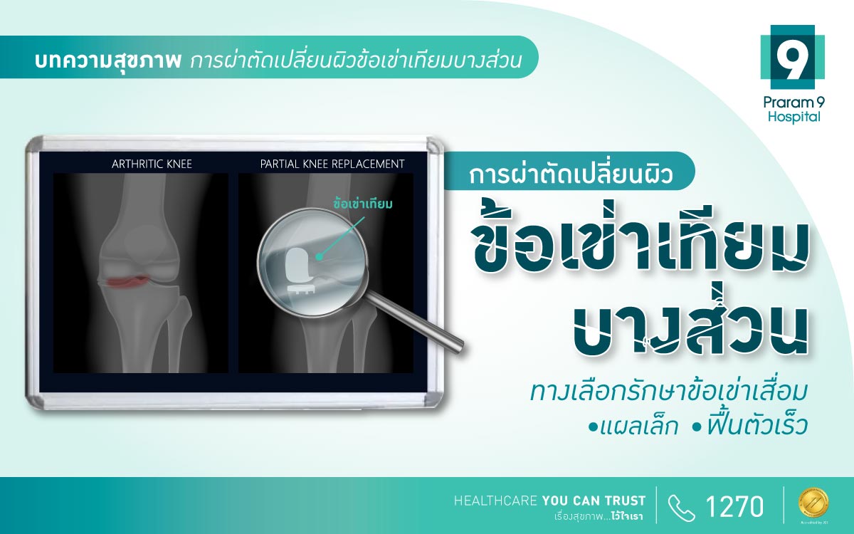 การผ่าตัดเปลี่ยนผิวข้อเข่าเทียมบางส่วน